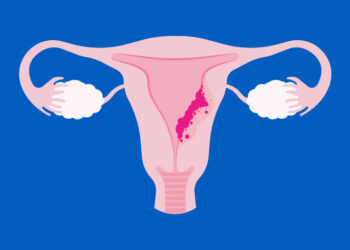 Prevén futuro alentador en terapias para cáncer de endometrio
