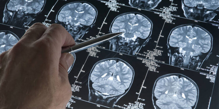 El alzhéimer es la principal causa de muerte en Japón desde 2015, según estudio