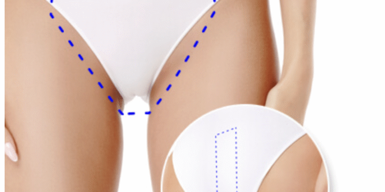 Kopay: depilación láser de barba, axilas y bikini en tendencia