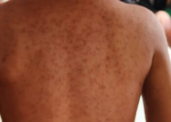 CDMX informa sobre alcaldías con más casos de sarampión y llama a no “estigmatizar”