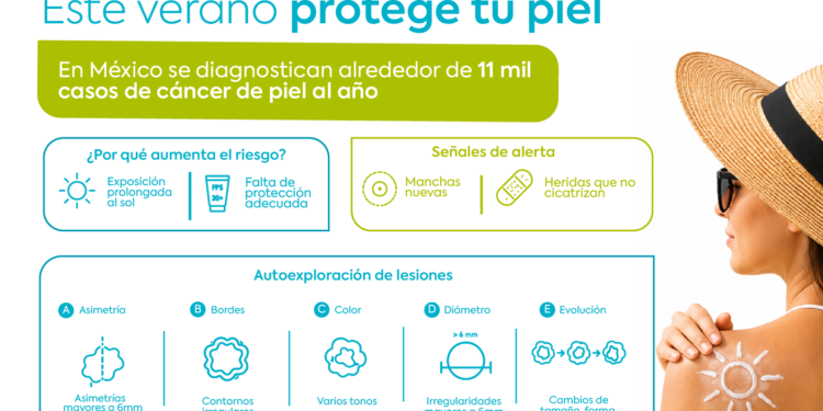 Vacaciones de verano elevan la exposición al sol y, con ello, los casos de cáncer de piel en México