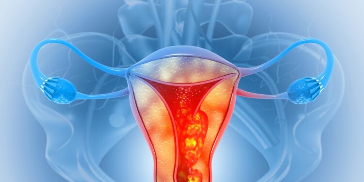Cáncer ginecológico: tratamientos menos agresivos con la misma eficacia